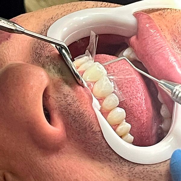 Aplicando Facetas de Resina 3 MM Clínica Odontológica